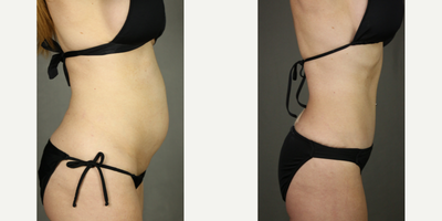 Tummy Tuck before and after photo