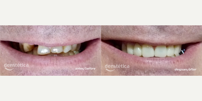 Dental Bridge before and after photo