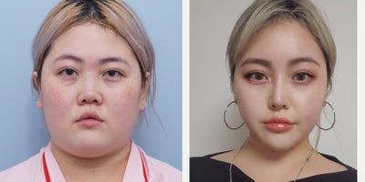 Thread Lift before and after photo