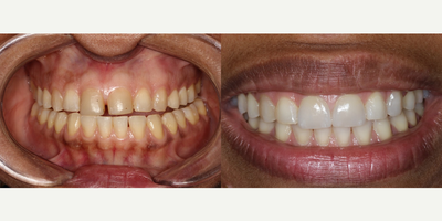 Tooth Repair before and after photo