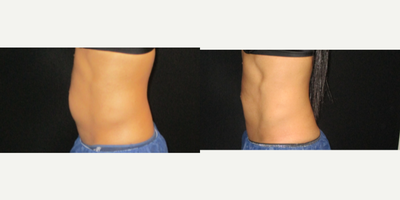 CoolSculpting before and after photo