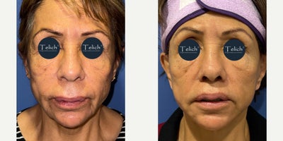 Facelift before and after photo