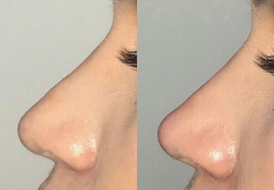 Nonsurgical Nose Job before and after photo