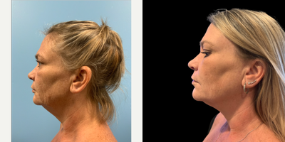 Renuvion before and after photo