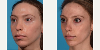 Revision Rhinoplasty before and after photo