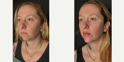 Botox before and after photo