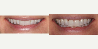 Braces before and after photo