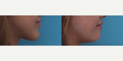 Genioplasty before and after photo