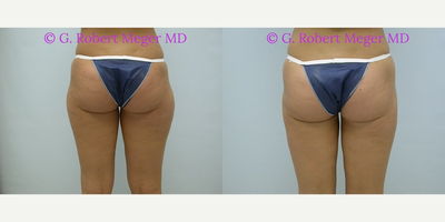 Liposuction before and after photo