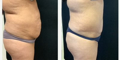 Tummy Tuck before and after photo