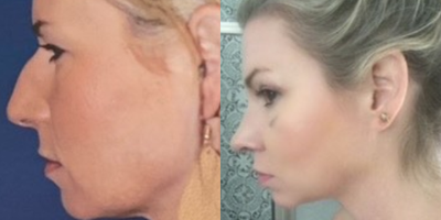 Chin Implant before and after photo