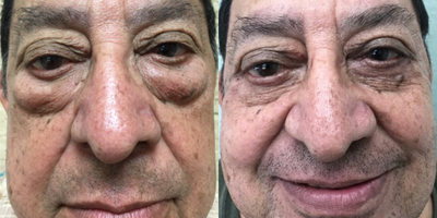 Eyelid Surgery before and after photo