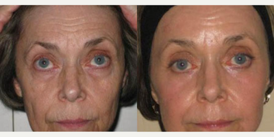 Laser Resurfacing before and after photo