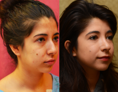 Rhinoplasty before and after photo