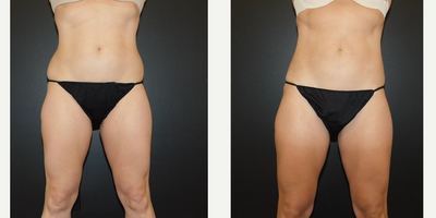 Smart Lipo before and after photo