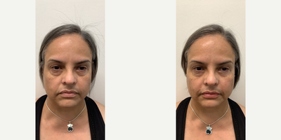 Cheek Fillers before and after photo