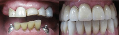 Dental Bonding before and after photo