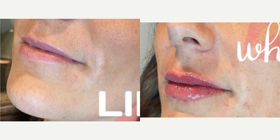 Dermal Fillers before and after photo