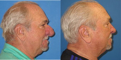 Facial Reconstructive Surgery before and after photo