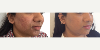 Fractional Laser before and after photo