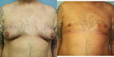 Gynecomastia Surgery before and after photo