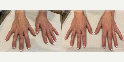 Hand Rejuvenation before and after photo