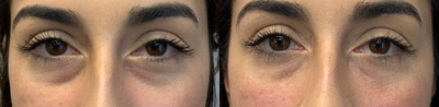 Volbella before and after photo