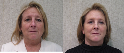 Facelift before and after photo