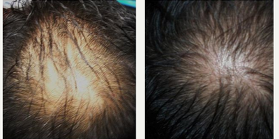PRP for Hair Loss before and after photo
