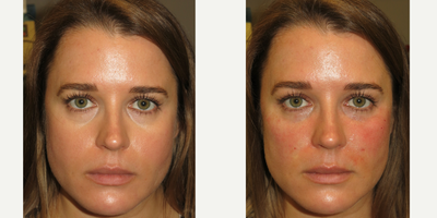 Restylane before and after photo