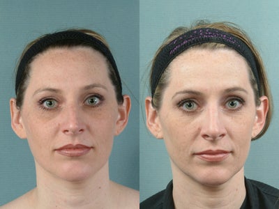 Rhinoplasty before and after photo