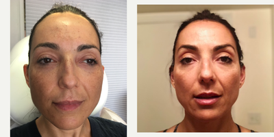 Volbella before and after photo