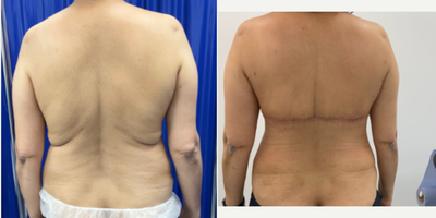 Back Lift before and after photo