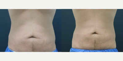 CoolSculpting before and after photo