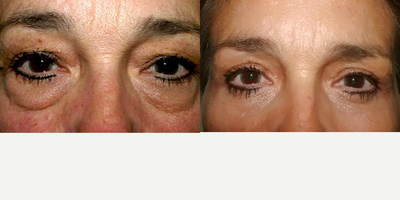 Eyelid Surgery before and after photo