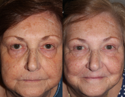 Eyelid Surgery before and after photo