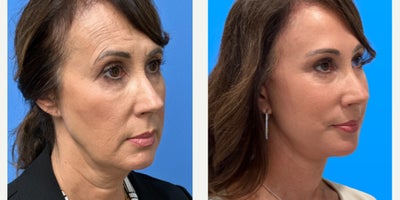 Facelift before and after photo