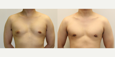 Gynecomastia Surgery before and after photo