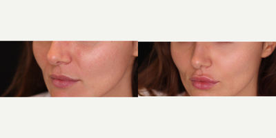 Lip Fillers before and after photo