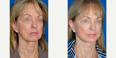 Mini Facelift before and after photo