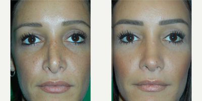 Revision Rhinoplasty before and after photo