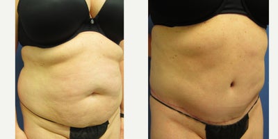 Tummy Tuck before and after photo