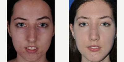 Chin Implant before and after photo