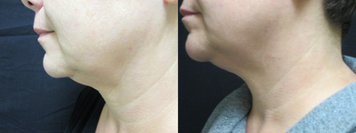 Exilis before and after photo