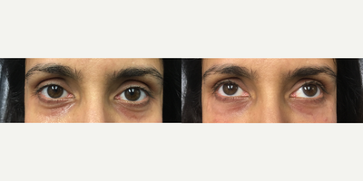 Restylane Lyft before and after photo