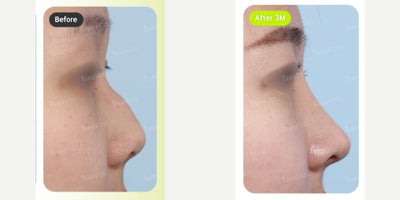 Asian Rhinoplasty before and after photo