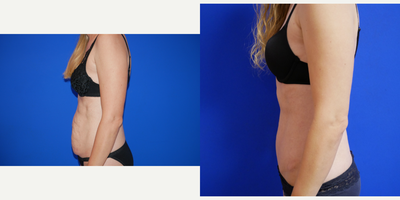 Vaser Liposuction before and after photo