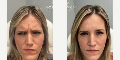 Botox before and after photo