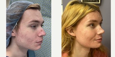 Forehead Reduction before and after photo
