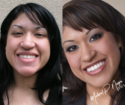 Lumineers before and after photo